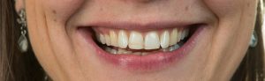 gebit voor behandeling met facings 2 | Mondzorgcentrum Wiranto & Go